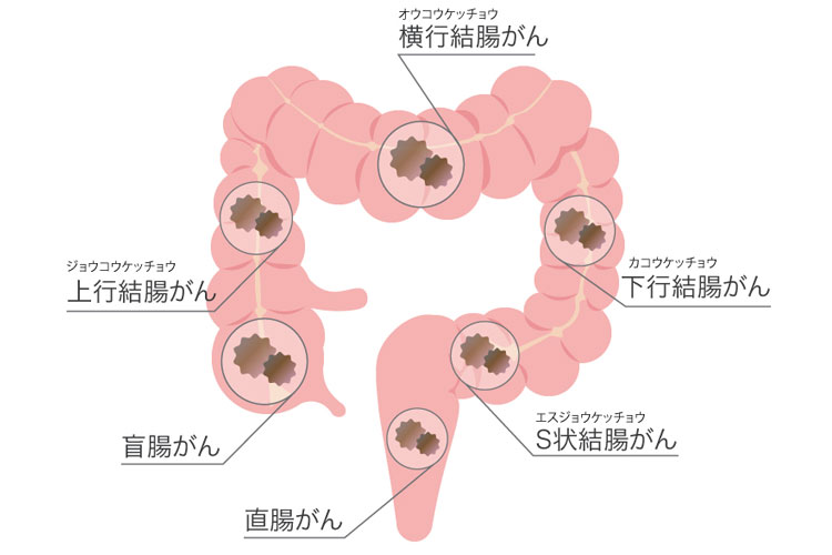 大腸癌はどうやってできてくるの?