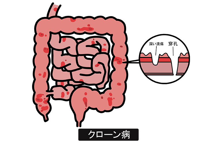 クローン病とは