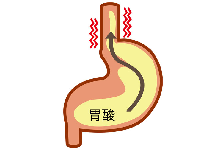 逆流性食道炎
