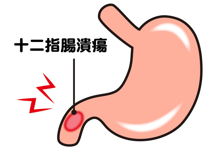 胃十二指腸潰瘍とは